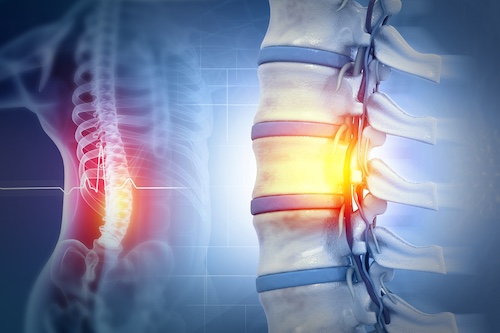 Illustration of a human spine highlighting spinal cord injuries, emphasizing areas of damage and potential nerve fiber impact related to car accidents.